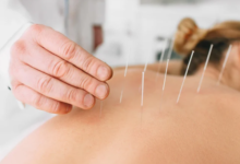 The Connection Between Acupuncture and Improved Sleep Quality